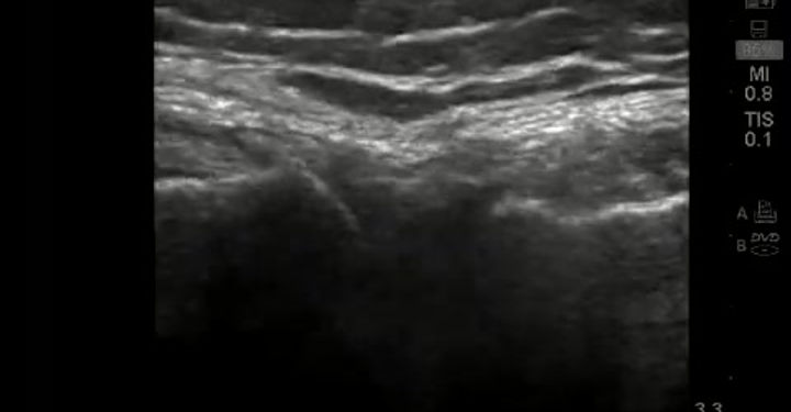 Dr Steven Sampson demonstrates ultrasound exam of the Lateral Meniscus